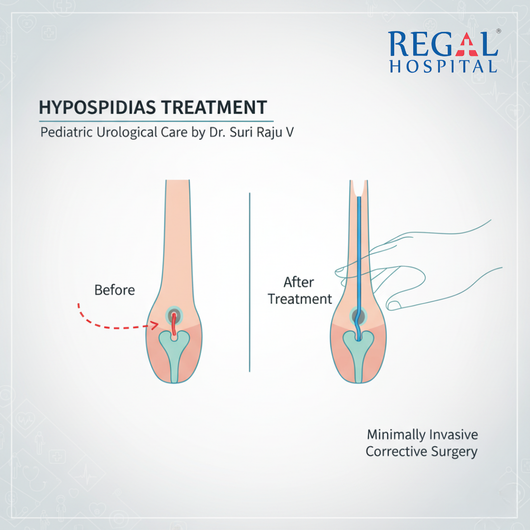 The Beginning of Treatment for Hypospadias in Bangalore  